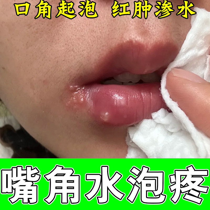 水泡长嘴上真菌泡嘴唇上火起泡肿痒唇上火起水泡染水泡肿疼草本膏