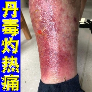 丹毒专用膏下肢皮肤红肿畏寒疼痛肿胀灼热流火皮肤专用修复软膏