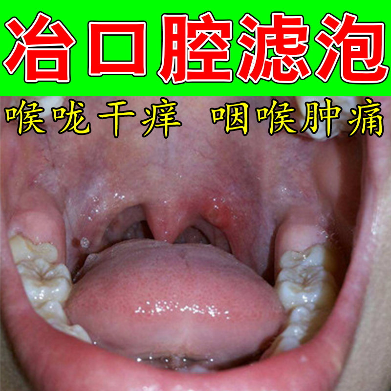 滤泡增生咽喉疼口水泡肿胀慢性咽后壁淋巴舌根喉咙红肿异物喷剂
