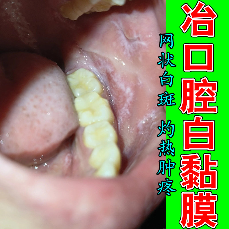 口腔扁平白黏膜专用黏膜修复反复口腔黏膜纤维白斑纤维化喷剂