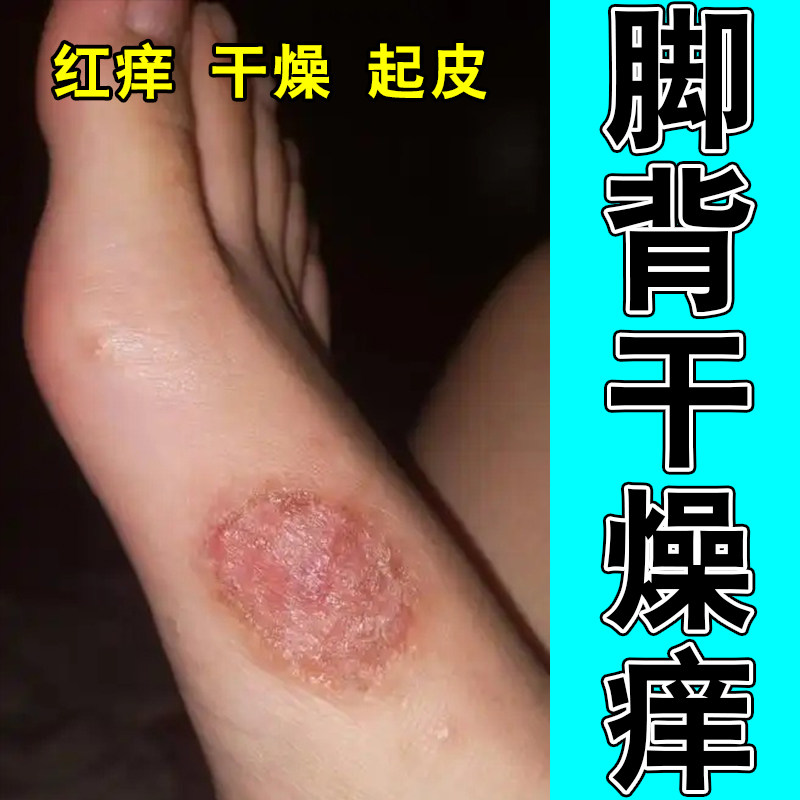 脚背痒脚背上脚面起红点粗糙红疙瘩脚面干燥脱屑植物萃取膏