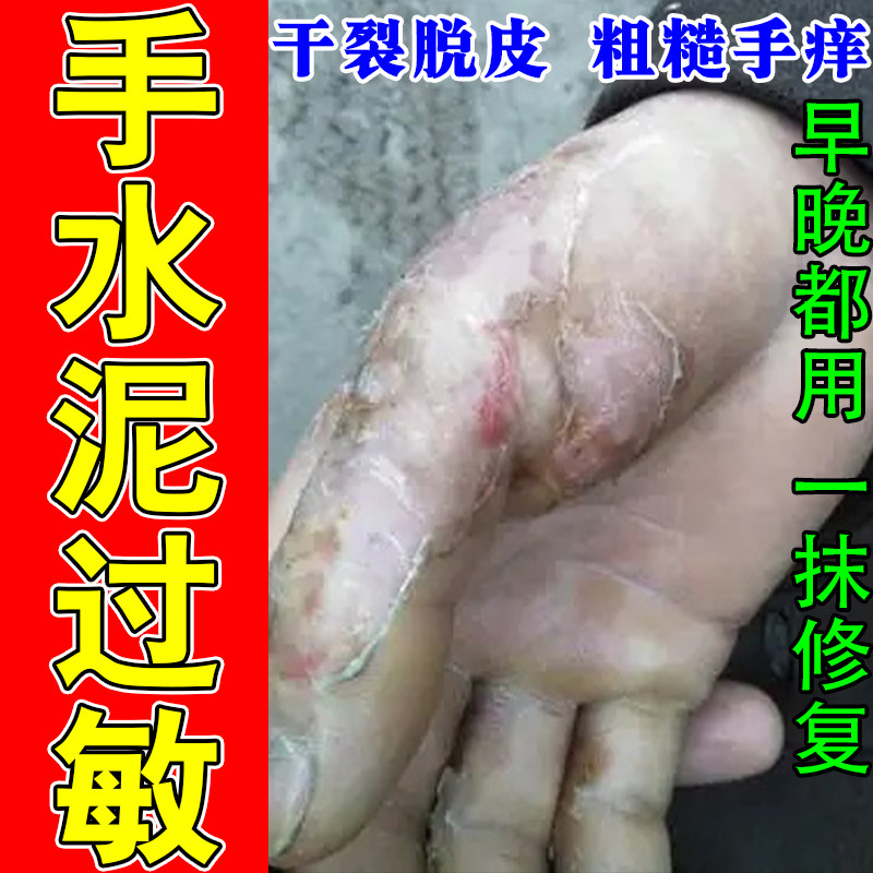 冶水泥过敏身上痒起疙瘩建筑手痒皮肤消毒护理（消）