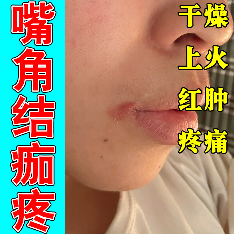 嘴角干燥结痂嘴巴干裂脱皮上火嘴角开裂起泡红肿口周不适草本复膏