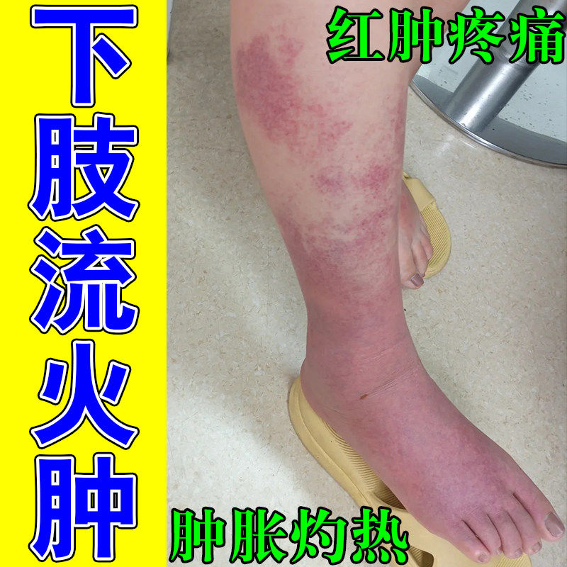 冶下肢红肿痛流火皮肤红肿灼热痒下肢畏寒脚脖子疼痛灼热流火膏