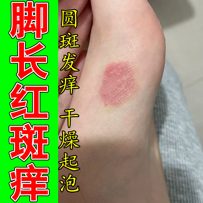 冶脚上脱皮起屑痒脚侧脱屑角化疙瘩起红点干燥粗糙痒修护软膏
