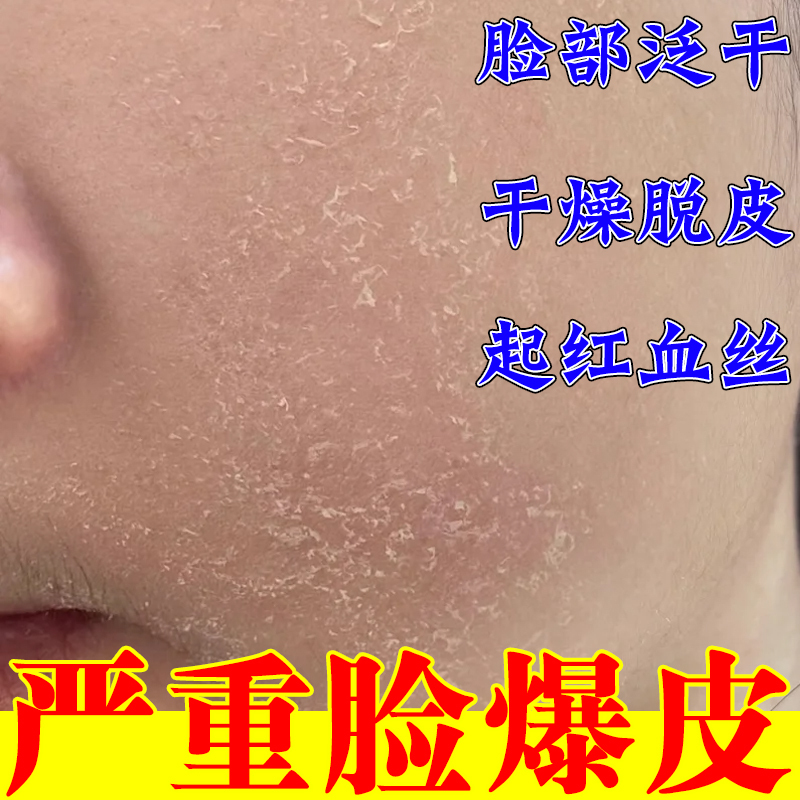 脸上起皮掉皮干皮脸上起皮干燥脸干掉皮秋冬季脸干起皮干燥脸干痒