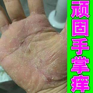 手干燥脱皮角化症手背蜕皮粗糙痒真菌染手指关节长硬疙瘩裂口子