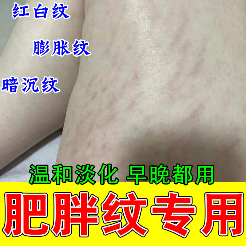 消生长纹肥胖纹大腿专用成人学生生长肥胖纹明显修复乳膏