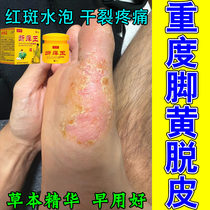 掌趾干裂跖角质化干杂粗糙手脚红斑干裂蜕皮角皮掌跖干裂修护膏