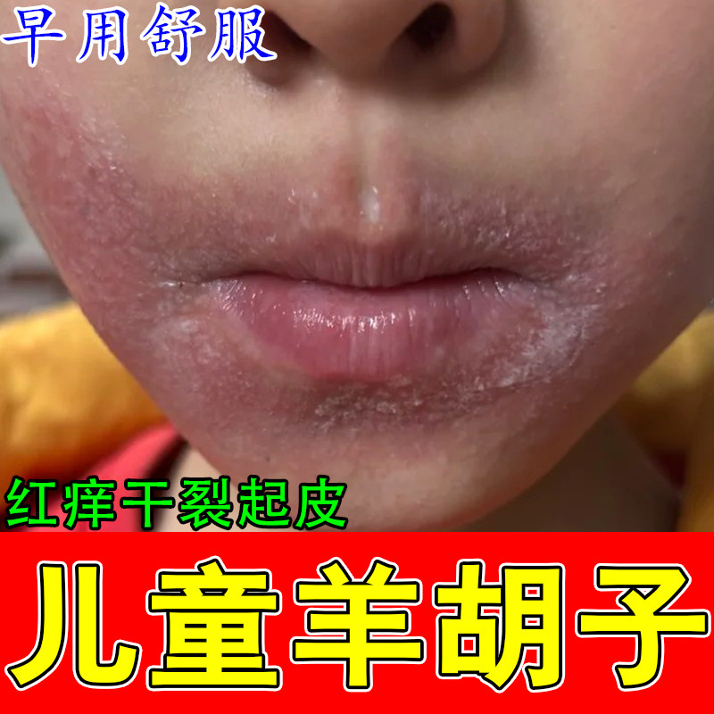 羊胡子儿童嘴巴一圈红结肿痂疼痛小孩舔嘴唇干起燥皮脱皮肿疼膏