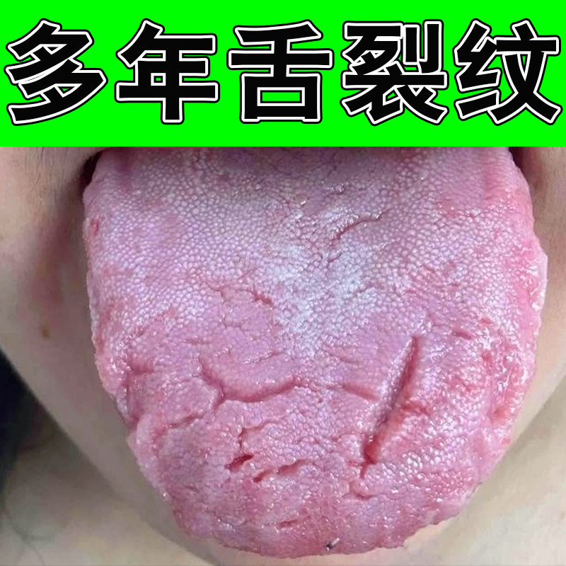 冶舌头裂纹地图舌痕舌有裂纹舌头发白湿气刺痛裂纹舌草本修护软膏