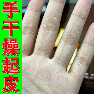 手干燥粗糙起皮治手足严重脱皮手痒干裂痒滋润专用修护霜