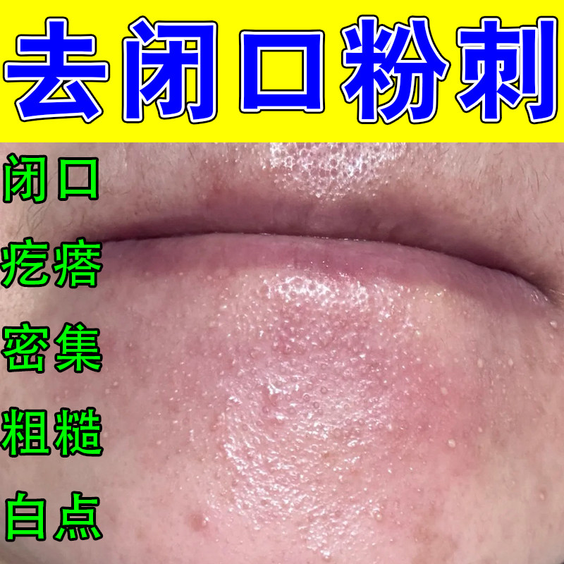 粉刺闭口脸部敏感长痘起小疙瘩逆光疙瘩下巴额头痘红修护软膏