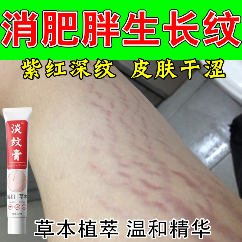 成人青少年肥胖纹修复霜淡化去生长纹大腿内侧纹路多专用修护膏