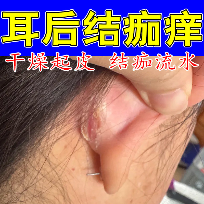 耳道干燥起皮结痂耳痒外耳道皮屑结痂耳内不适真菌痒流水修护膏