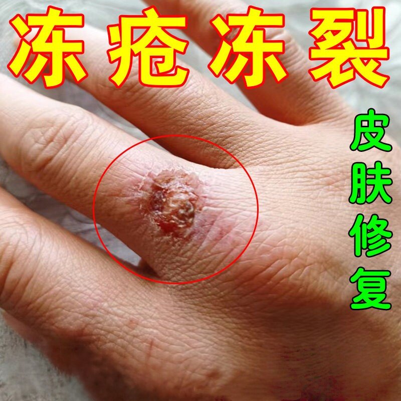 冻疮膏手脚耳朵防冻冻疮膏消肿痒冻伤膏防冻膏防裂冻疮