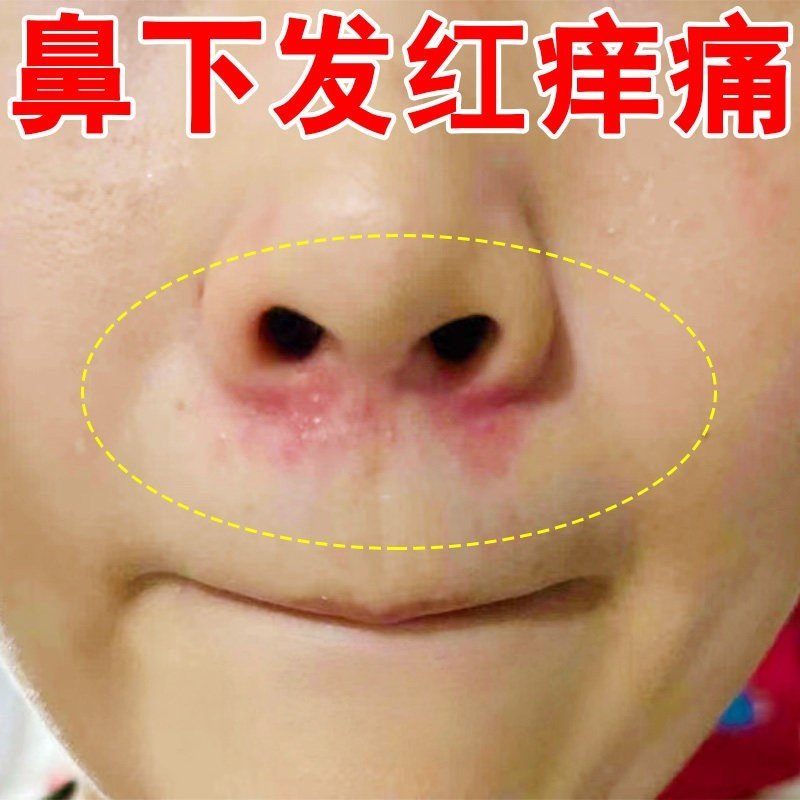 鼻子两侧发红脱皮脂溢性皮焱鼻翼两侧鼻子两边泛红起皮酒糟鼻痒