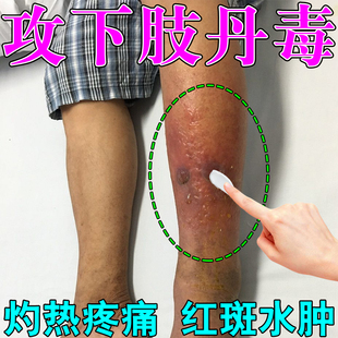 小腿丹毒专用软膏下肢畏寒肿胀疼痛红斑水泡流脓灼热流火皮肤发黑