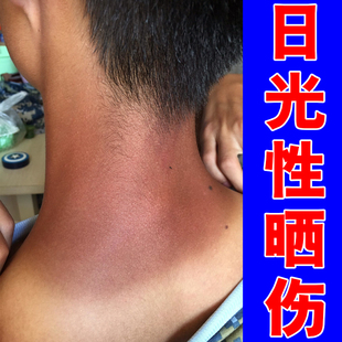 脖子被太阳晒伤专用膏脖子皮肤红肿痒日光性皮炎修复涂抹膏