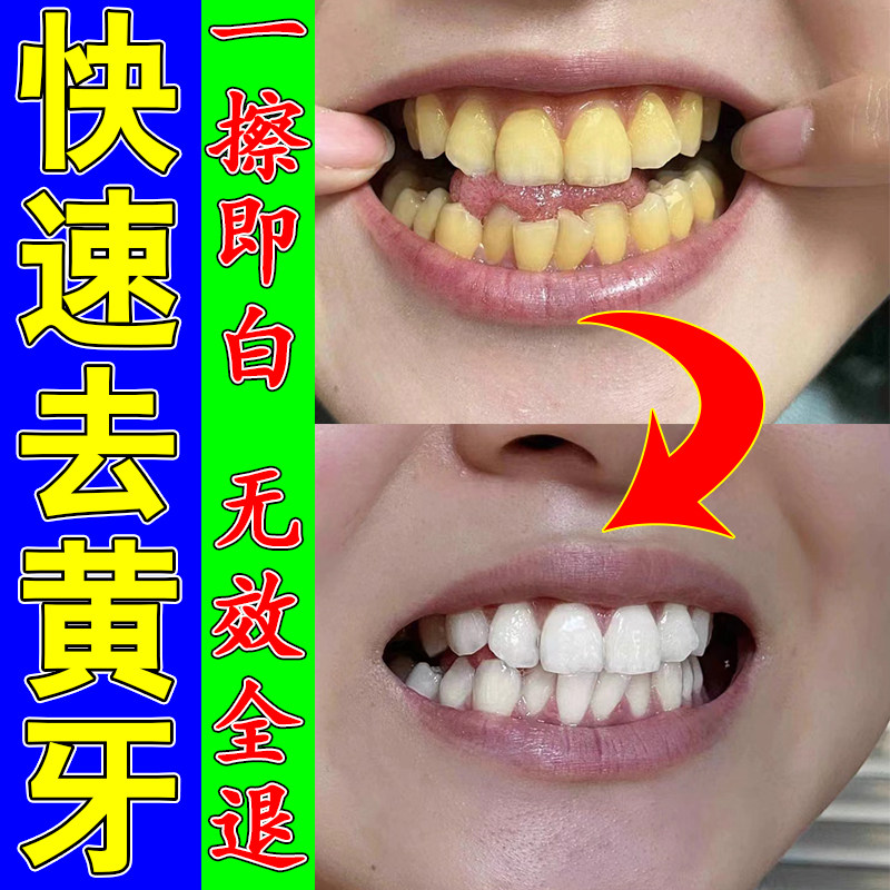牙斑净牙齿美白快速去黄牙茶渍烟渍除污垢牙石牙菌斑清洁洗牙神器