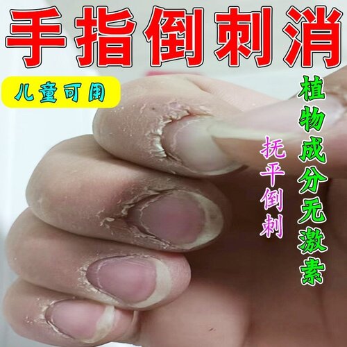指甲边缘长倒刺去除神器一抹去肉刺死皮手指甲边缘表皮撕裂脱皮