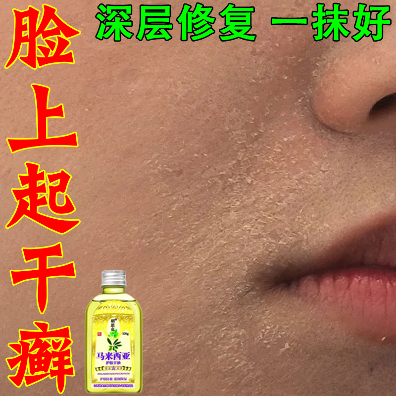 脸干燥粗糙嘴起皮脱皮掉皮有碎屑鼻子下巴起干癣痒修护擦脸甘油