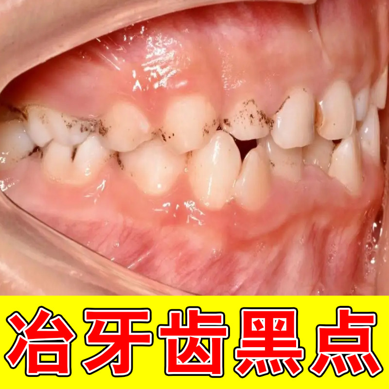氟斑牙去黑线黑渍牙窝沟专用清洁牙齿蛀牙菌斑牙缝发黑