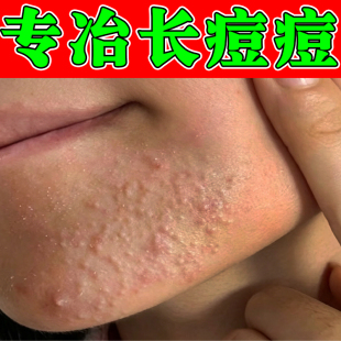 脸颊腮边痘红肿脓包硬块疙瘩下巴闭口粉刺痘专用痘痘外用修复软膏
