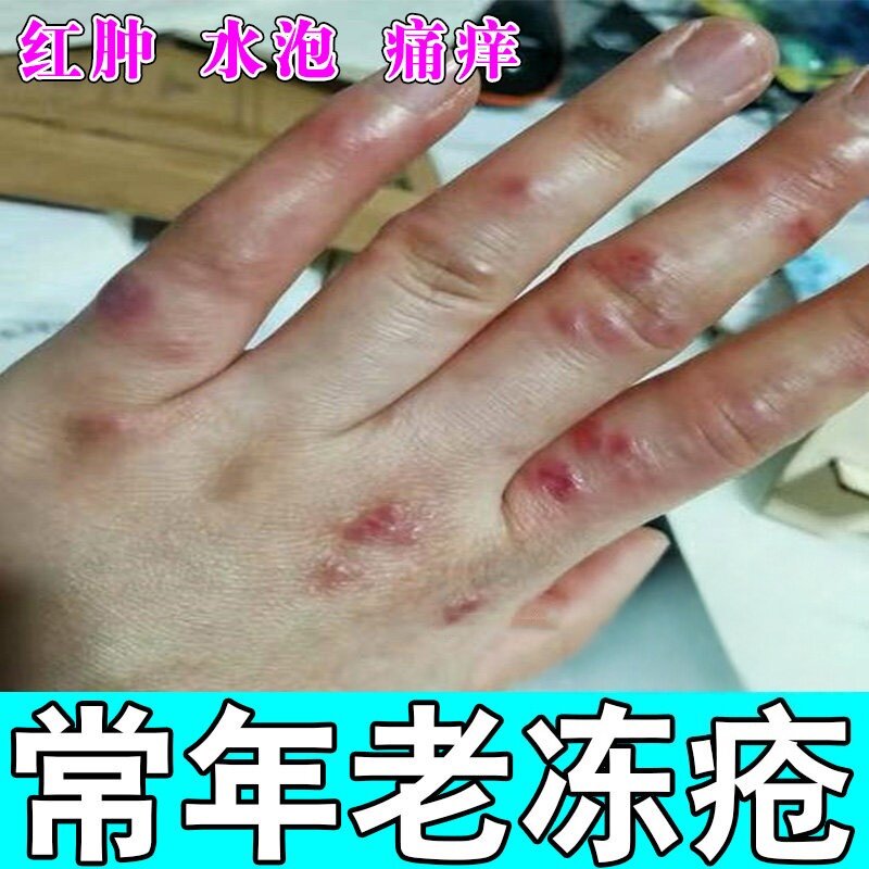 冻疮膏痒冻伤膏正品防冻冻手治手裂的护手霜成人儿童脸耳朵