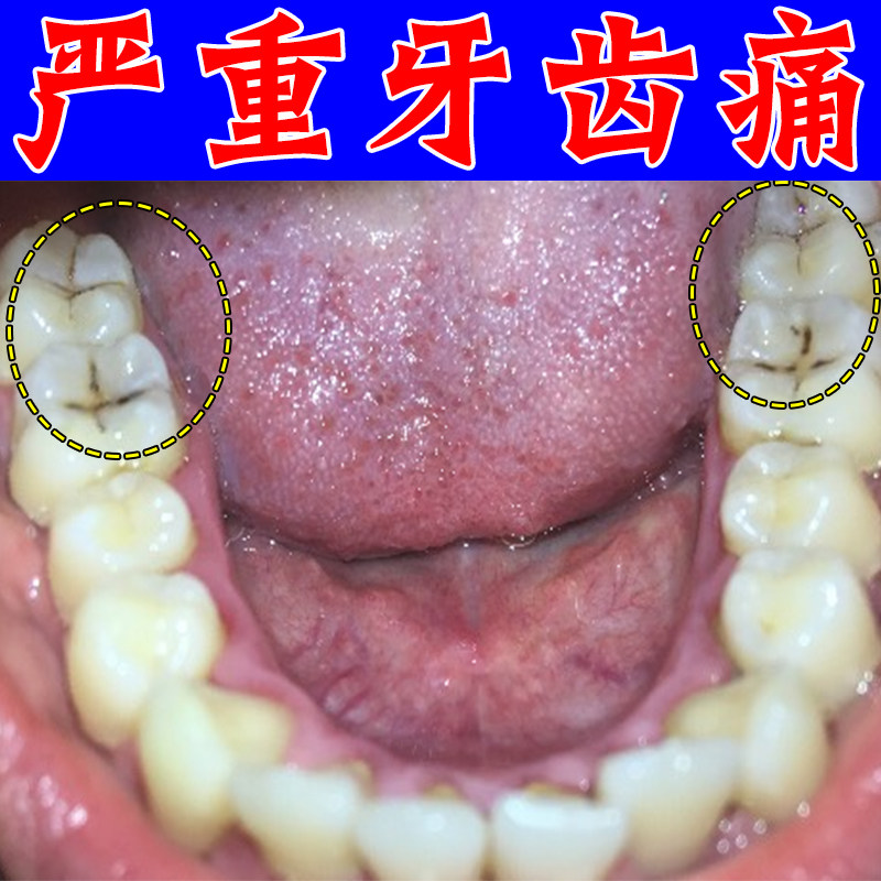 牙疼牙痛智齿牙龈肿痛红肿上火牙根鼓包出血专用喷剂