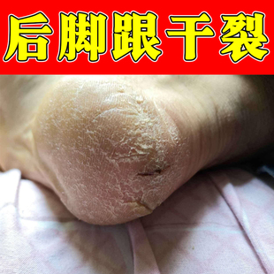 脚脱皮专用膏脚底板脚掌干燥开裂掉皮蜕皮脚发痒起皮专用