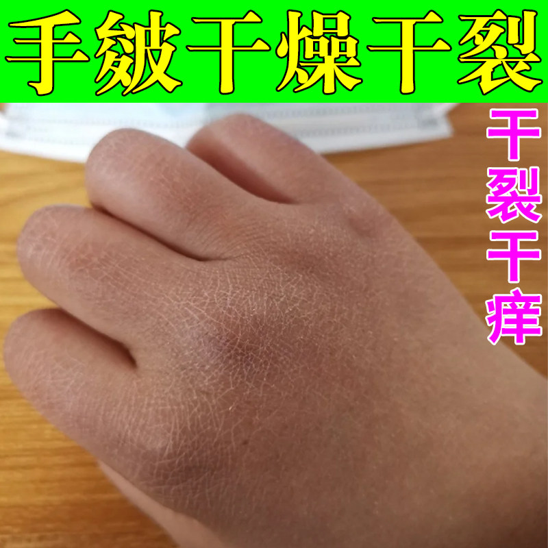 手上起皮干燥脱皮手指手手背干裂爆皮裂纹掉皮手裂口软膏