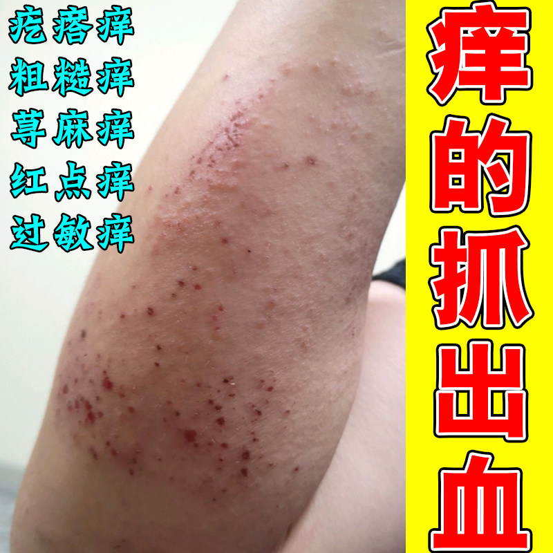 痒的抓出血胳膊红肿刺挠长红点疙瘩痒过敏神经性紫外线干燥痒痘痘