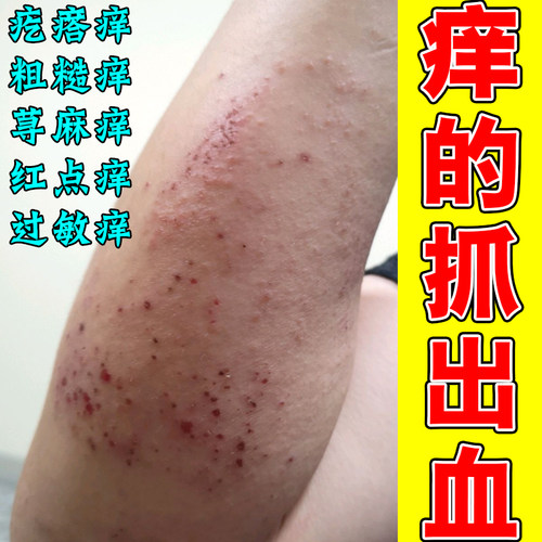 痒的抓出血胳膊红肿刺挠长红点疙瘩痒神经性紫外线干燥痒痘痘
