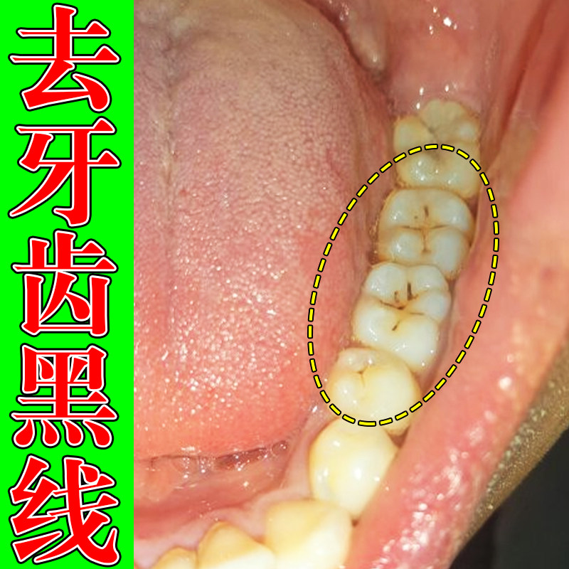 牙齿黑线牙缝黑渍牙发黄牙窝清洁蛀牙虫洞牙菌斑牙齿神器