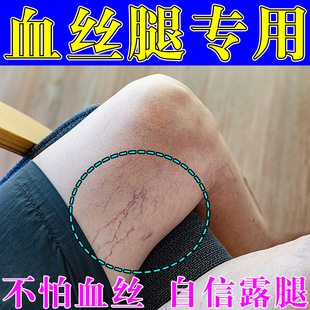 去除男女性腿上有红血丝青筋凸起静脉曲张毛细血管扩张修复的软膏