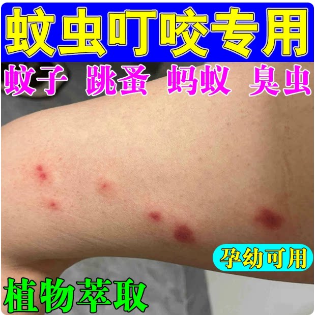 胳膊手臂红点点蚊虫叮咬痒舒缓痒膏婴儿用驱蚊跳蚤臭痒软膏