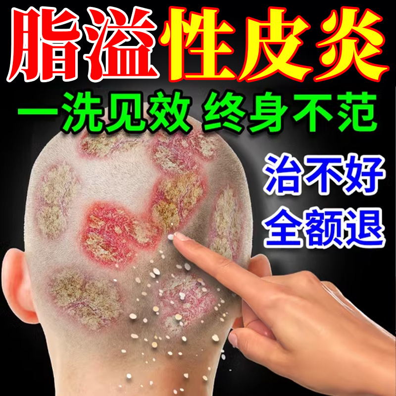 【二硫化硒】脂溢性皮炎洗发水