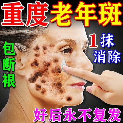 去斑祛雀斑官方正品祛斑老年斑强力去除旗舰店第一名黄褐斑美白霜