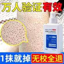 去鸡皮疙瘩毛囊角质角化鸡皮肤百分之20尿素身体乳磨砂膏美白