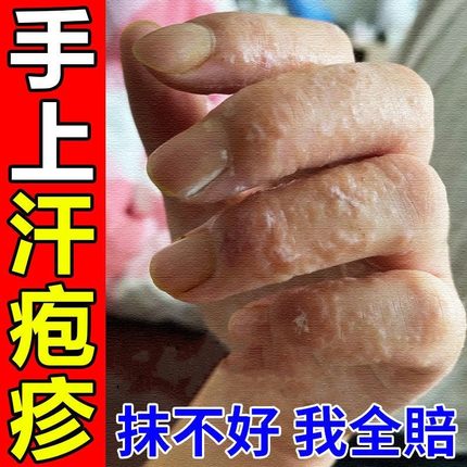 鹅掌风手脚儿童手部干燥手开裂药膏止痒过敏本草起泡治疗皮肤病