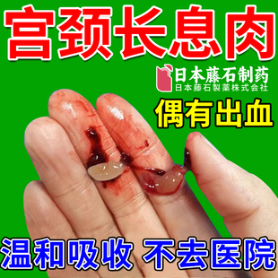 子宫内膜息肉中药贴宫颈息肉消化散调理内膜炎增厚月经淋漓不尽XP