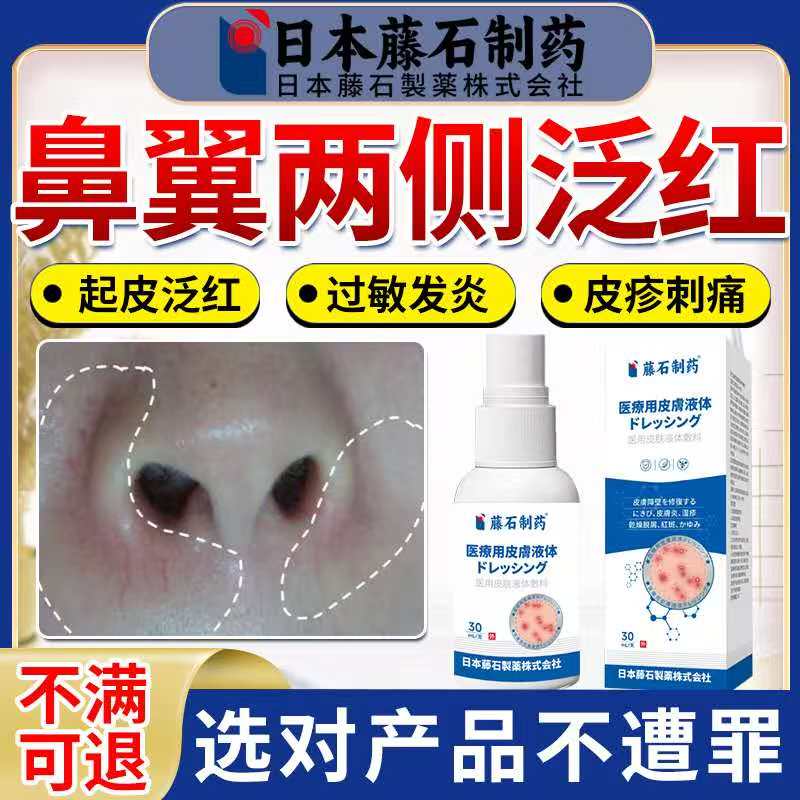 鼻翼两侧泛红脂溢性皮炎