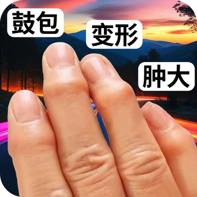 手指关节变形肿大粗大增生疼痛酸麻僵硬类风湿性关节焱专用