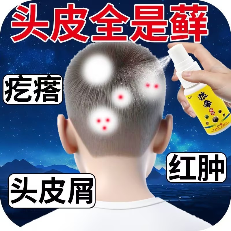 狼毒头藓头皮屑头皮痒头皮发红长疙瘩红斑狼毒喷剂头藓头皮藓
