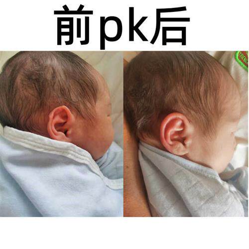 极速宝宝耳朵矫正器新生儿耳廓纠正器婴儿耳畸P形矫形器招风耳垂