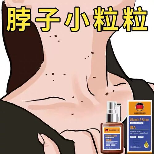 【德国专研】脖子脸上颗粒神器寻常足底趾手腋下皮赘