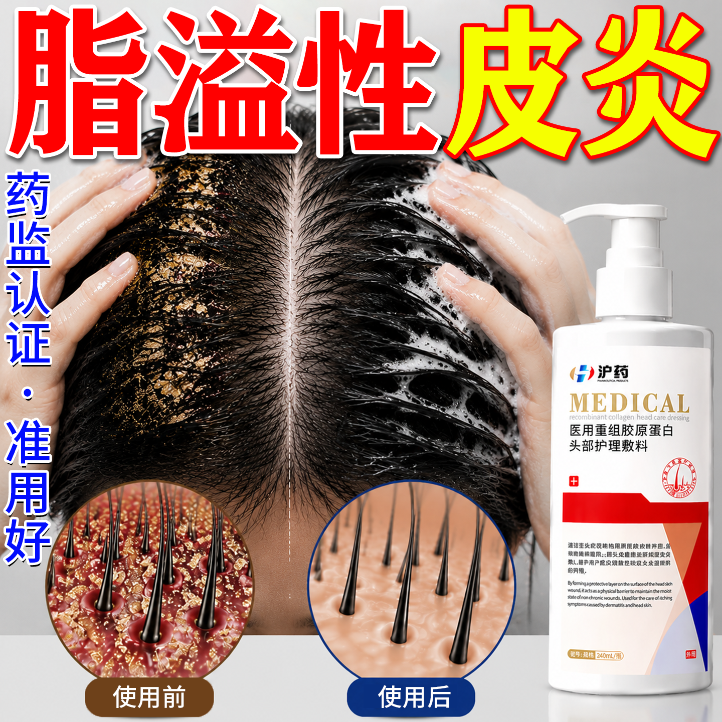 沪药-脂溢性皮炎毛囊炎洗发水