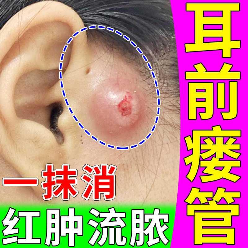 耳前瘘管药膏耳仓发炎流脓红肿中耳炎消炎异味红肿瘙痒鼓包滴耳液