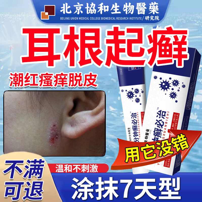 脸上耳根长癣真菌感染红肿皮肤干燥脱皮脱屑专止痒用去顽固皮炎vp